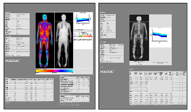 DEXA 検査レポート例