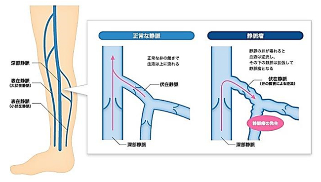 下肢静脈瘤説明図